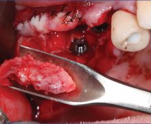 fig 5-oralimplanto fig 5-oralimplanto